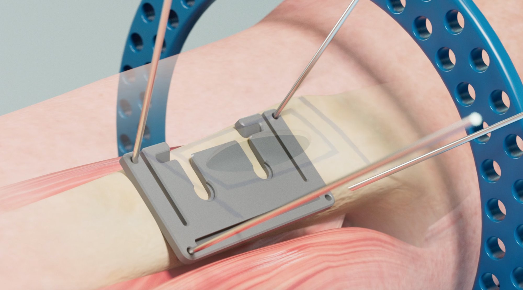 Excelsior System — Soft Tissue Interface