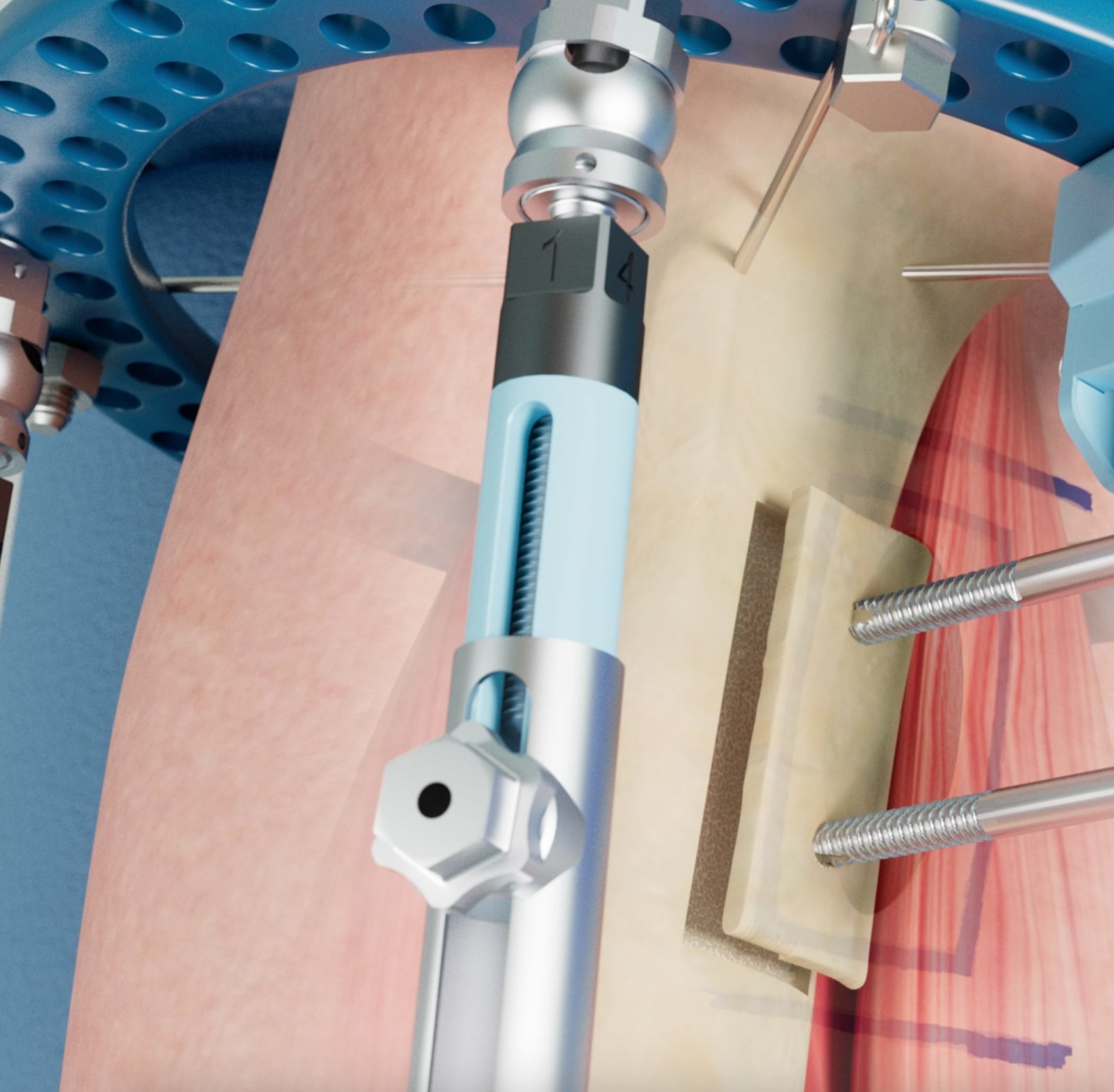 Excelsior System — Fixator Assembly